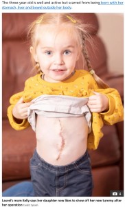 手術により臓器が無事体内に（画像は『The Sun　2021年8月8日付「LAUREL’S BATTLE Girl, 3, born ‘inside out’ is home after undergoing lifesaving surgery」（Credit: Splash）』のスクリーンショット）