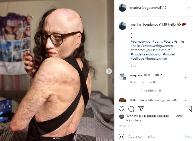 「傷は強さの象徴」とマリナさん（画像は『Marina Bogdanova　2021年3月13日付Instagram「Hello」』のスクリーンショット）