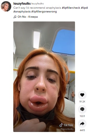 大きく腫れ上がった唇（画像は『lauzyfaulks　2021年8月19日付TikTok「Can’t say I’d recommend anaphylaxis」』のスクリーンショット）