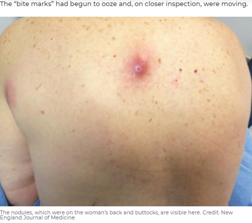 皮膚の一部が赤く隆起した女性（画像は『7NEWS　2021年8月14日付「Woman’s ‘mosquito bites’ turn out to be parasite larvae burrowed into back」（Credit: New England Journal of Medicine）』のスクリーンショット）