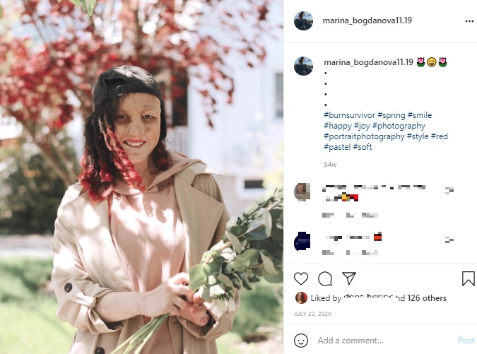 1歳で身体の65％に火傷を負った女性（画像は『Marina Bogdanova　2020年7月22日付Instagram』のスクリーンショット）