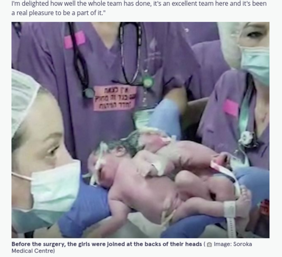 頭部が結合して誕生した双子の赤ちゃん（画像は『The Mirror　2021年9月6日付「Conjoined twin sisters attached at head successfully separated after 12 hour operation」（Image: Soroka Medical Centre）』のスクリーンショット）