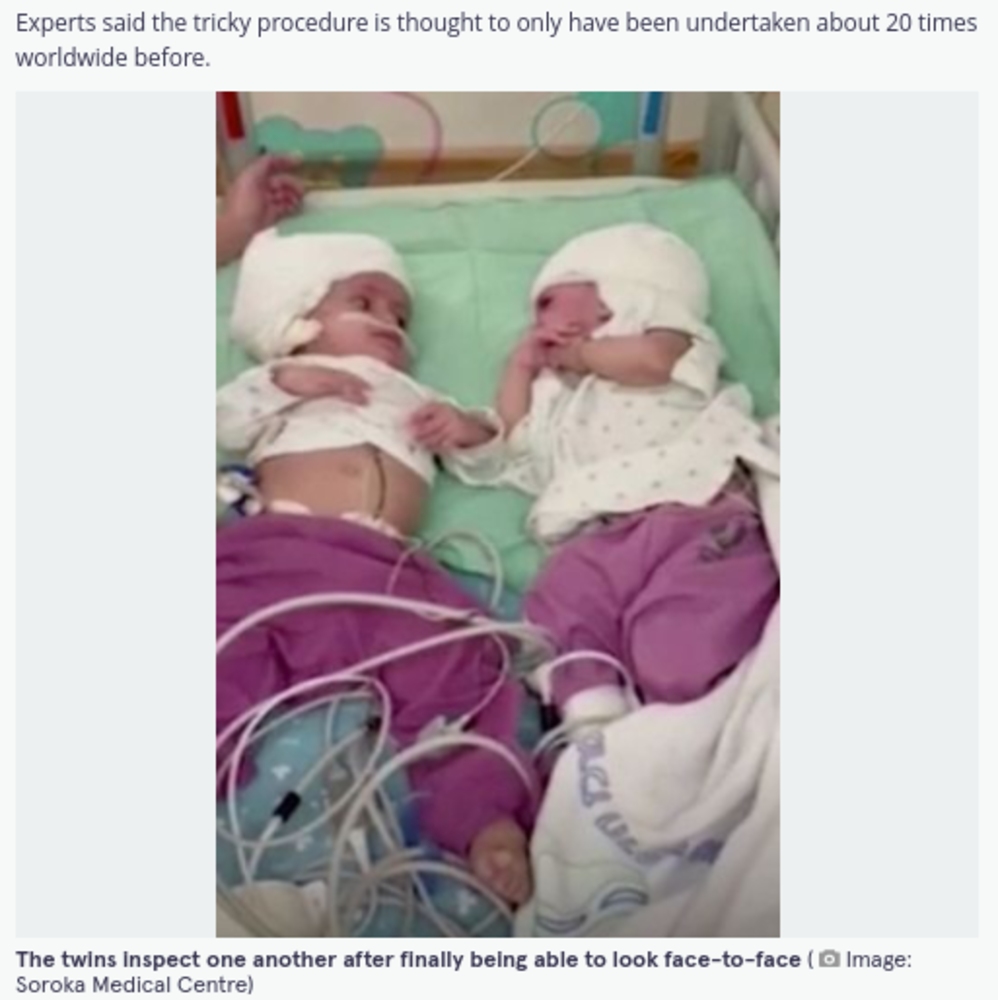 生まれて初めて離れて寝る双子の赤ちゃん（画像は『The Mirror　2021年9月6日付「Conjoined twin sisters attached at head successfully separated after 12 hour operation」（Image: Soroka Medical Centre）』のスクリーンショット）