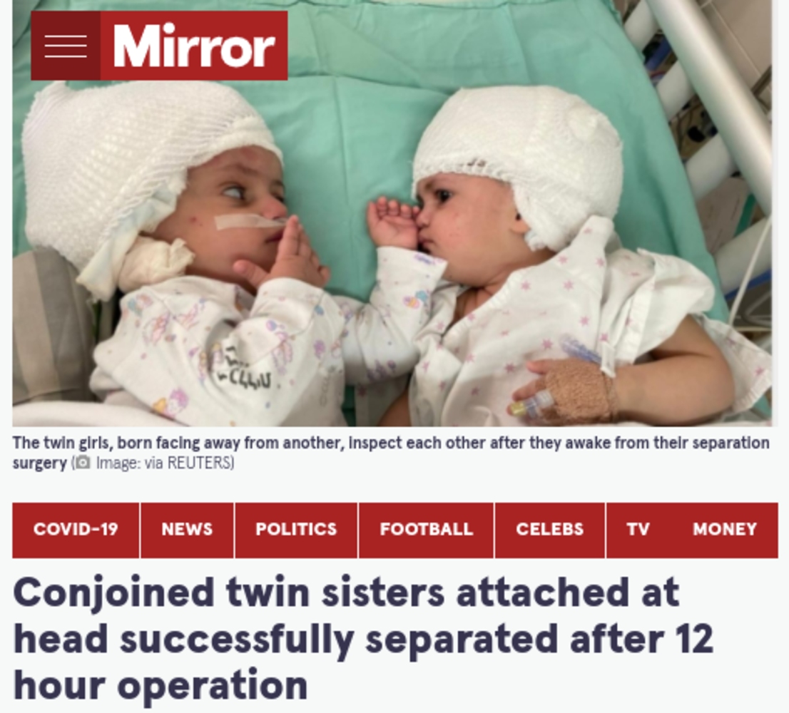 初めてお互いを見つめ合う双子の赤ちゃん（画像は『The Mirror　2021年9月6日付「Conjoined twin sisters attached at head successfully separated after 12 hour operation」（Image: via REUTERS）』のスクリーンショット）