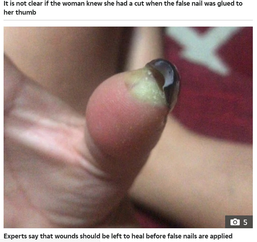 黒く変色してしまった爪（画像は『The Sun　2021年9月28日付「NAIL FAIL Woman has thumb amputated after gluing false nail over wound causing horror infection to ooze puss」』のスクリーンショット）