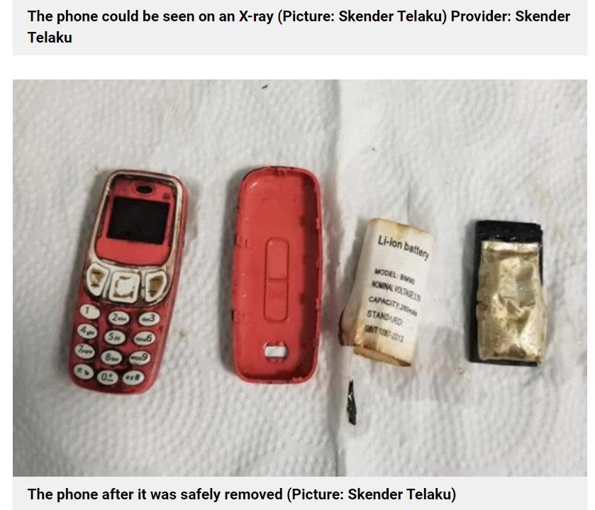 体の中で3つに分かれていた携帯電話（画像は『Metro　2021年9月5日付「Man somehow swallows entire phone and then needs doctors to remove it」（Picture: Skender Telaku）』のスクリーンショット）