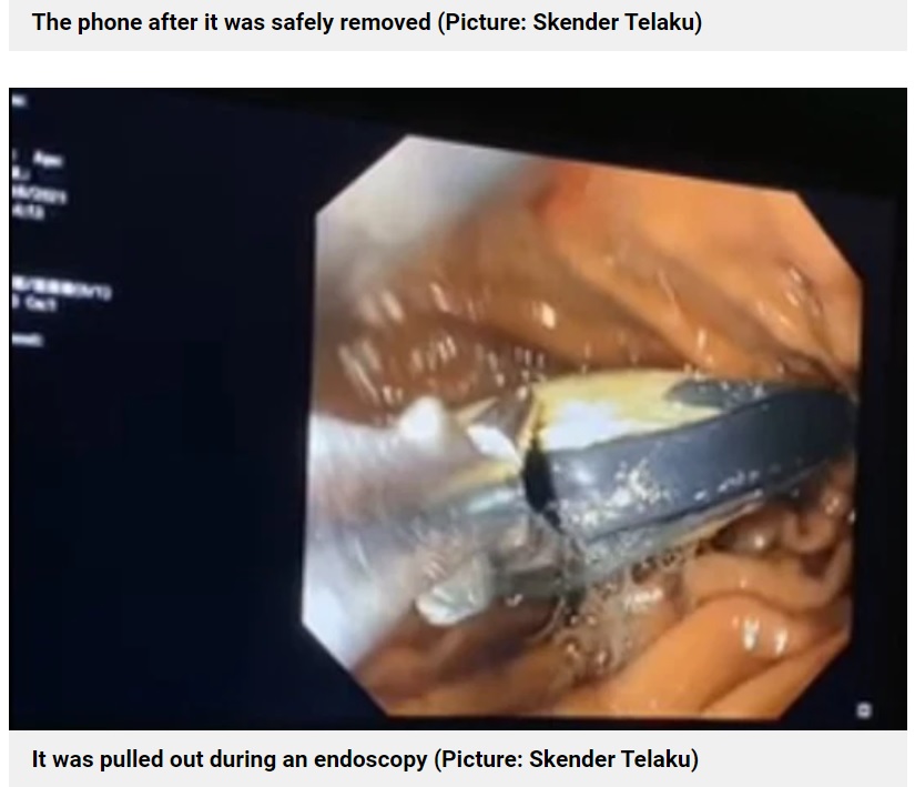 内視鏡を用いて口から携帯を取り出すことに成功（画像は『Metro　2021年9月5日付「Man somehow swallows entire phone and then needs doctors to remove it」（Picture: Skender Telaku）』のスクリーンショット）