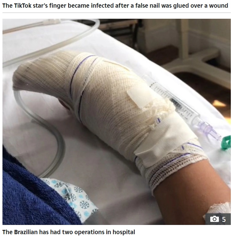 ジェニファーさんの手は包帯でグルグル巻きに（画像は『The Sun　2021年9月28日付「NAIL FAIL Woman has thumb amputated after gluing false nail over wound causing horror infection to ooze puss」』のスクリーンショット）