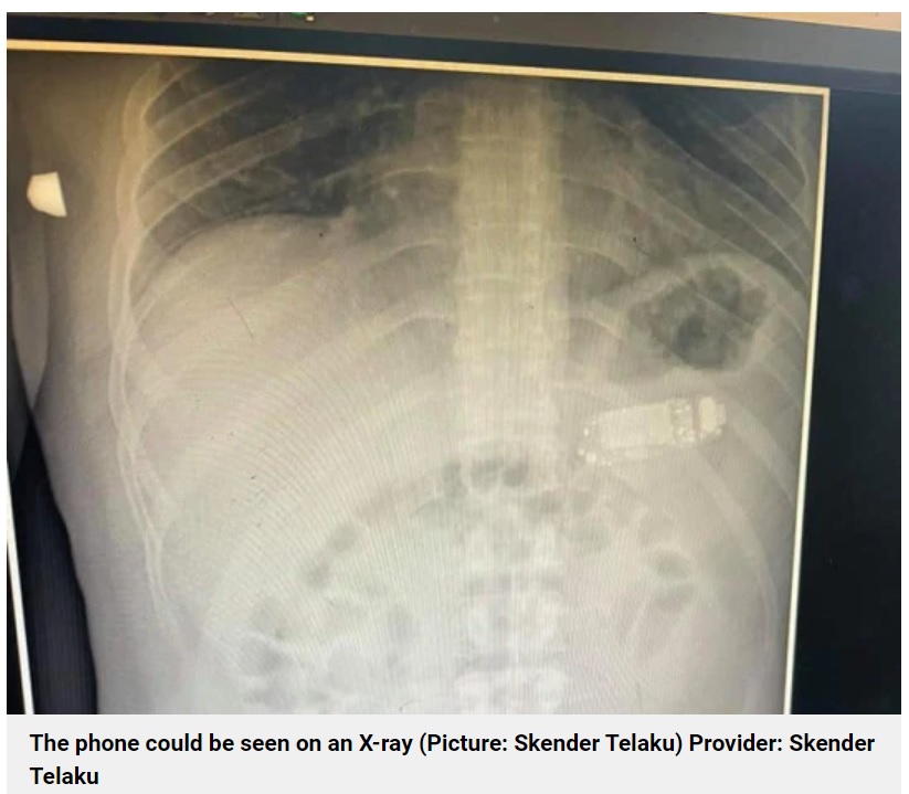 はっきりと携帯の形が確認されたレントゲン写真（画像は『Metro　2021年9月5日付「Man somehow swallows entire phone and then needs doctors to remove it」（Picture: Skender Telaku）』のスクリーンショット）
