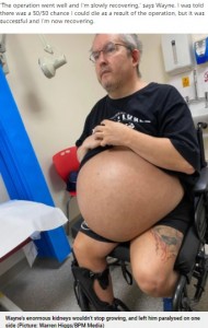 まるで妊婦のように膨らんだ手術前のお腹（画像は『Metro　2021年10月6日付「Man who had giant kidneys that wouldn’t stop growing has life-saving surgery to remove them」（Pictures: Warren Higgs/BPM Media）』のスクリーンショット）