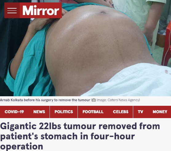10キロ近くの腫瘍を抱えていた男性（画像は『The Mirror　2021年10月13日付「Gigantic 22lbs tumour removed from patient's stomach in four-hour operation」（Image: Caters News Agency）』のスクリーンショット）