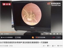 耳のかゆみで病院を訪れた女性、外耳道を行き来するクモを検査のカメラが捉える（中国）＜動画あり＞