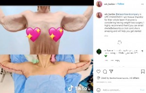 腕のたるみを取る手術のビフォーアフター（画像は『Kayla Lavende　2020年12月31日付Instagram「＠eliasortizandcompany is LIFE CHANGING!!!」』のスクリーンショット）