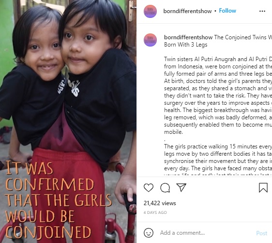 歩行練習をする2人（画像は『Born Different　2021年9月28日付Instagram「The Conjoined Twins Who Were Born With 3 Legs」』のスクリーンショット）