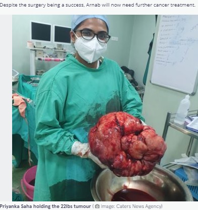 摘出された巨大な腫瘍（画像は『The Mirror　2021年10月13日付「Gigantic 22lbs tumour removed from patient’s stomach in four-hour operation」（Image: Caters News Agency）』のスクリーンショット）