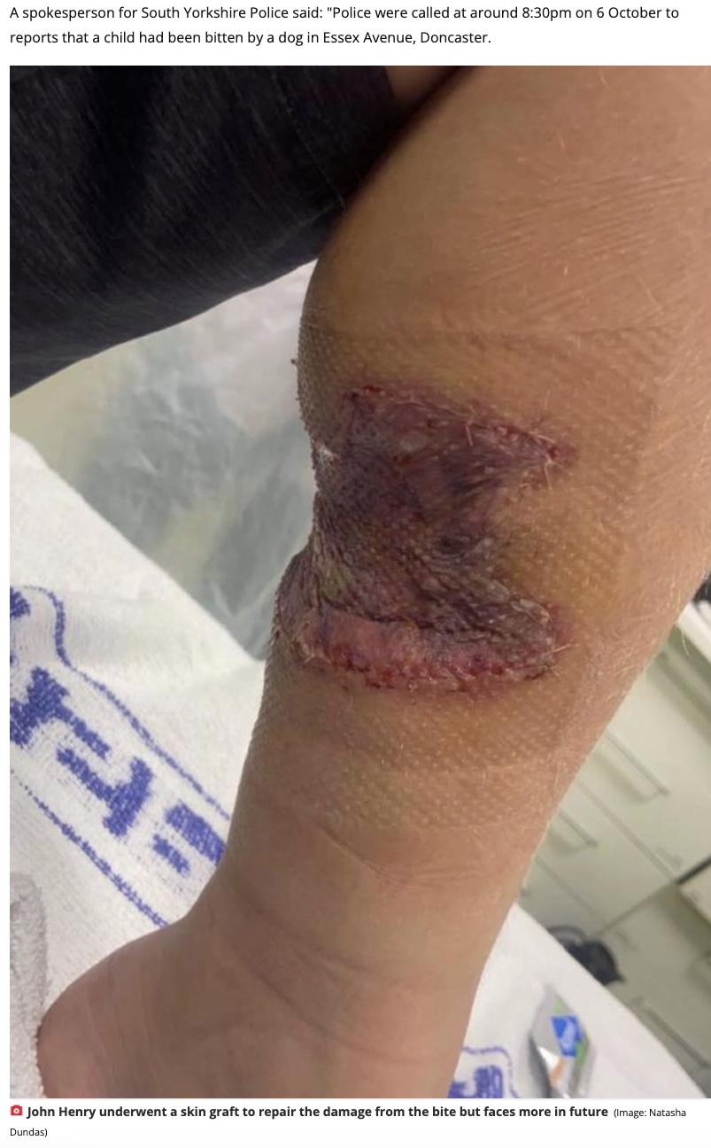 深くえぐられた傷跡（画像は『The Daily Star　2021年11月7日付「Boy, 10, in wheelchair after dog attack left him ‘looking like shark bite victim’」（Image: Natasha Dundas）』のスクリーンショット）