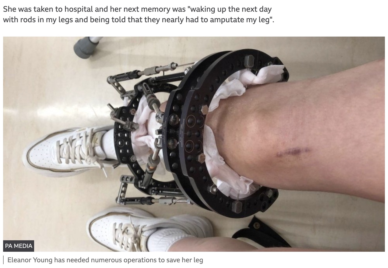 これまで8回にも及ぶ手術を受けたエレノアさん（画像は『BBC News　2021年11月26日付「E-moped crash warning from student who nearly lost leg」（PA MEDIA）』のスクリーンショット）
