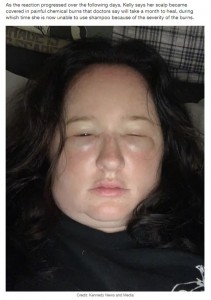 別人のように腫れ上がった顔（画像は『LADbible　2021年11月8日付「Woman Left ‘Looking Like Fat B****** From Austin Powers’ After Allergy」（Credit: Kennedy News and Media）』のスクリーンショット）