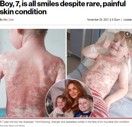 キオ君とニキータさんと一緒のカイ君（画像は『New York Post　2021年11月29日付「Boy, 7, is all smiles despite rare, painful skin condition」（Kennedy News and Media）』のスクリーンショット）