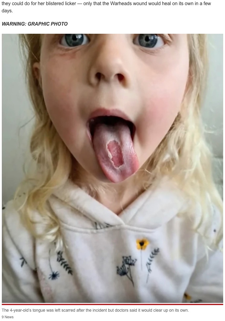 舌の表面が剥がれてしまったウィローちゃん（画像は『New York Post　2021年11月8日付「Girl, 4, burns hole in tongue after eating Warheads candy」（IMAGE:9News）』のスクリーンショット）