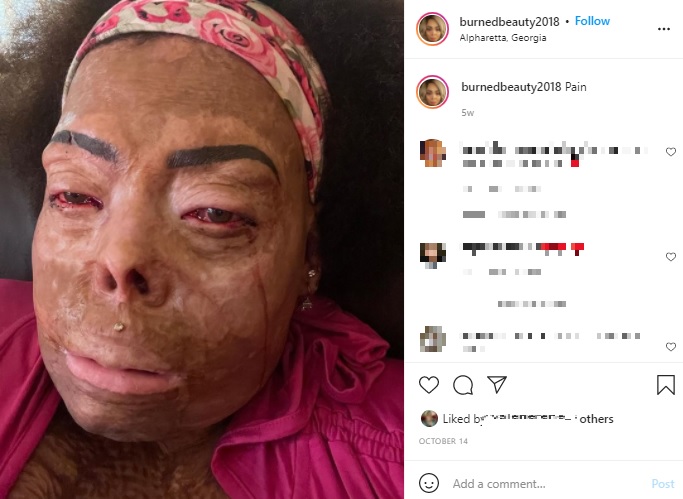 顔に重度の火傷を負ったトーニャさん（画像は『Tonya Renee Meisenbach　2021年10月14日付Instagram「Pain」』のスクリーンショット）