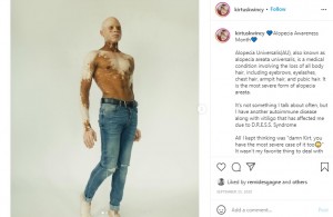 薬剤性過敏症症候群で全身脱毛症と白斑に（画像は『KirtusKwincy　2020年9月25日付Instagram「Alopecia Awareness Month」』のスクリーンショット）