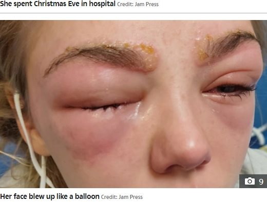 アレルギー反応で失明していた可能性も（画像は『The Sun　2021年12月29日付「DANGEROUS DYE My teenage daughter was left screaming in pain and almost lost her sight after Christmas brow treatment went wrong」（Credit: Jam Press）』のスクリーンショット）