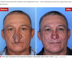 男性器がついているような手術前の鼻（左）と手術後（画像は『The Daily Star　2021年12月24日付「Man who spent years hiding ‘penis-shaped’ nose gets miracle surgery for Christmas」（Image: Dr. Thomas Romo）』のスクリーンショット）