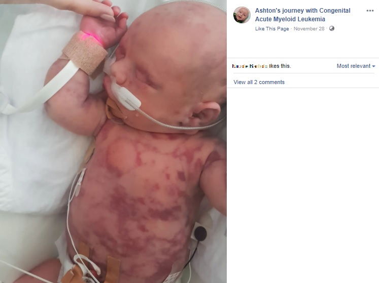 全身に紫斑ができていたアシュトン君（画像は『Ashton’s journey with Congenital Acute Myeloid Leukemia　2021年11月28日付Facebook「The difference that 12 months can make」』のスクリーンショット）