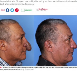 鼻の先にできものような塊が伸びているコンラドさん（左）と手術後（画像は『The Daily Star　2021年12月24日付「Man who spent years hiding ‘penis-shaped’ nose gets miracle surgery for Christmas」（Image: Dr. Thomas Romo）』のスクリーンショット）