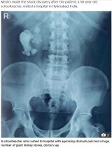 【海外発！Breaking News】激痛で病院に駆け込んだ男性、腎臓から156個の結石を摘出（印）
