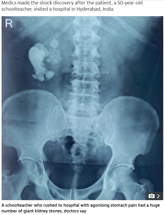大量の結石が写ったレントゲン写真（画像は『The Sun　2021年12月18日付「PEBBLE SCREECH Man, 50, has ‘record-breaking’ 156 kidney stones removed by docs during 3-hour surgery after agonising stomach pain」』のスクリーンショット）