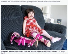 【海外発！Breaking News】生まれつき太ももの筋肉がない6歳少女、手術が成功し初めて歩く（スコットランド）