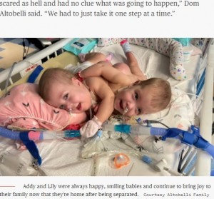 CHOPでケアを受ける手術前の2人（画像は『TODAY　2022年1月21日付「These conjoined twins were separated in a 10-hour surgery - and they’re thriving」（Courtesy Altobelli Family）』のスクリーンショット）