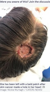 頭に穴が！（画像は『The Mirror　2022年1月21日付「Sunbed addict mum bravely shows off bald patch after skin cancer left hole in her head」（Image: Nickie Murtagh / CATERS NEWS）』のスクリーンショット）