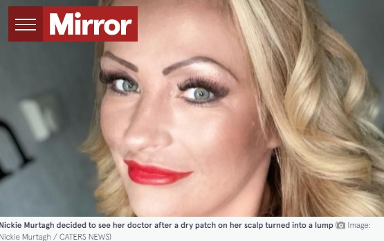 頭頂部に皮膚がんができた女性（画像は『The Mirror　2022年1月21日付「Sunbed addict mum bravely shows off bald patch after skin cancer left hole in her head」（Image: Nickie Murtagh / CATERS NEWS）』のスクリーンショット）