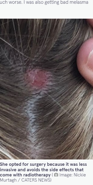 時間の経過とともに大きくなった塊（画像は『The Mirror　2022年1月21日付「Sunbed addict mum bravely shows off bald patch after skin cancer left hole in her head」（Image: Nickie Murtagh / CATERS NEWS）』のスクリーンショット）