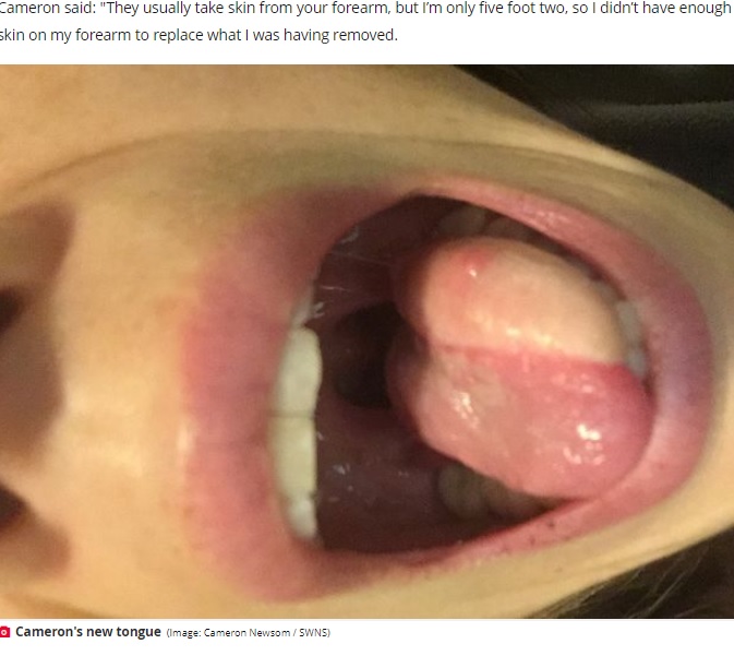 左側を再建した舌（画像は『The Daily Star　2022年1月18日付「Mum who lost half her tongue in cancer fight has new one made from her leg」（Image: Cameron Newsom / SWNS）』のスクリーンショット）