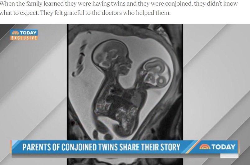 胸腹結合体だった2人（画像は『TODAY　2022年1月21日付「These conjoined twins were separated in a 10-hour surgery - and they’re thriving」（Courtesy Altobelli Family）』のスクリーンショット）