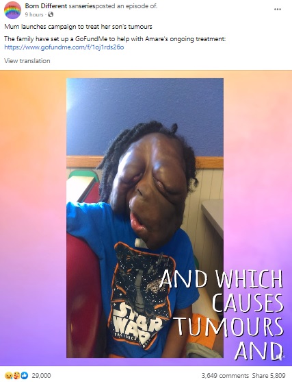 小さい頃からいじめられたというアマーリ君（画像は『Born Different　2022年1月2日付Facebook「Mum Launches Campaign To Treat Her Son’s Tumours」』のスクリーンショット）