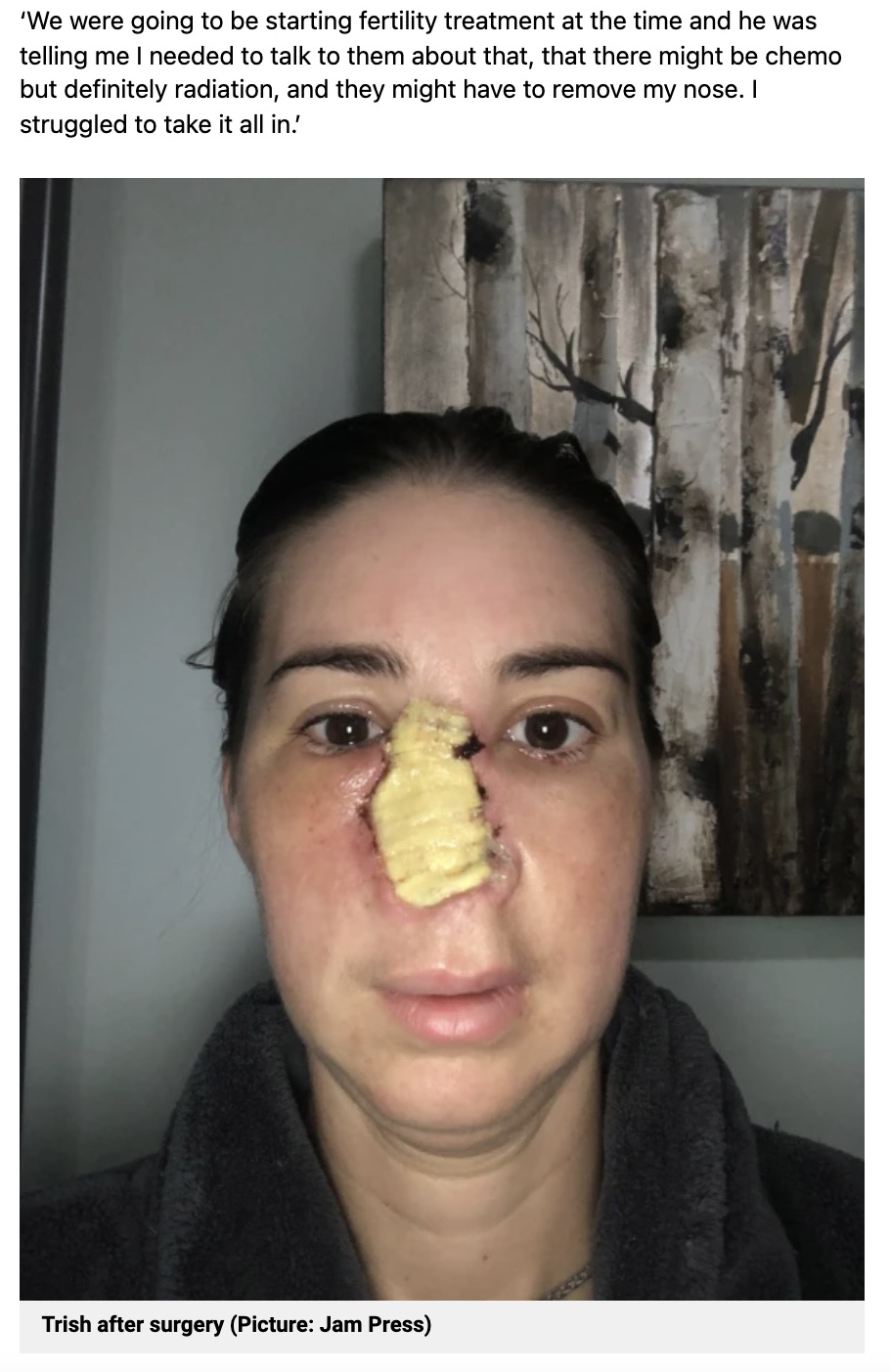 鼻腔がんで鼻を切除したトリッシュさん（画像は『Metro　2022年2月17日付「Woman who felt pain while washing her face discovers tumour and has to have nose removed」（Picture: Jam Press）』のスクリーンショット）