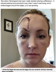 切除手術直後のレイチェルさん（画像は『Metro　2022年2月9日付「Mum has ‘huge chunk’ of forehead removed after ‘tiny mark’ turned out to be skin cancer」（Picture: Kennedy News）』のスクリーンショット）