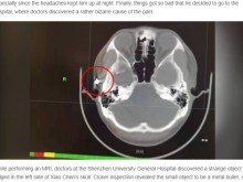 【海外発！Breaking News】空気銃の弾が頭蓋骨の中に20年！　半年間頭痛に悩まされた28歳男性（中国）