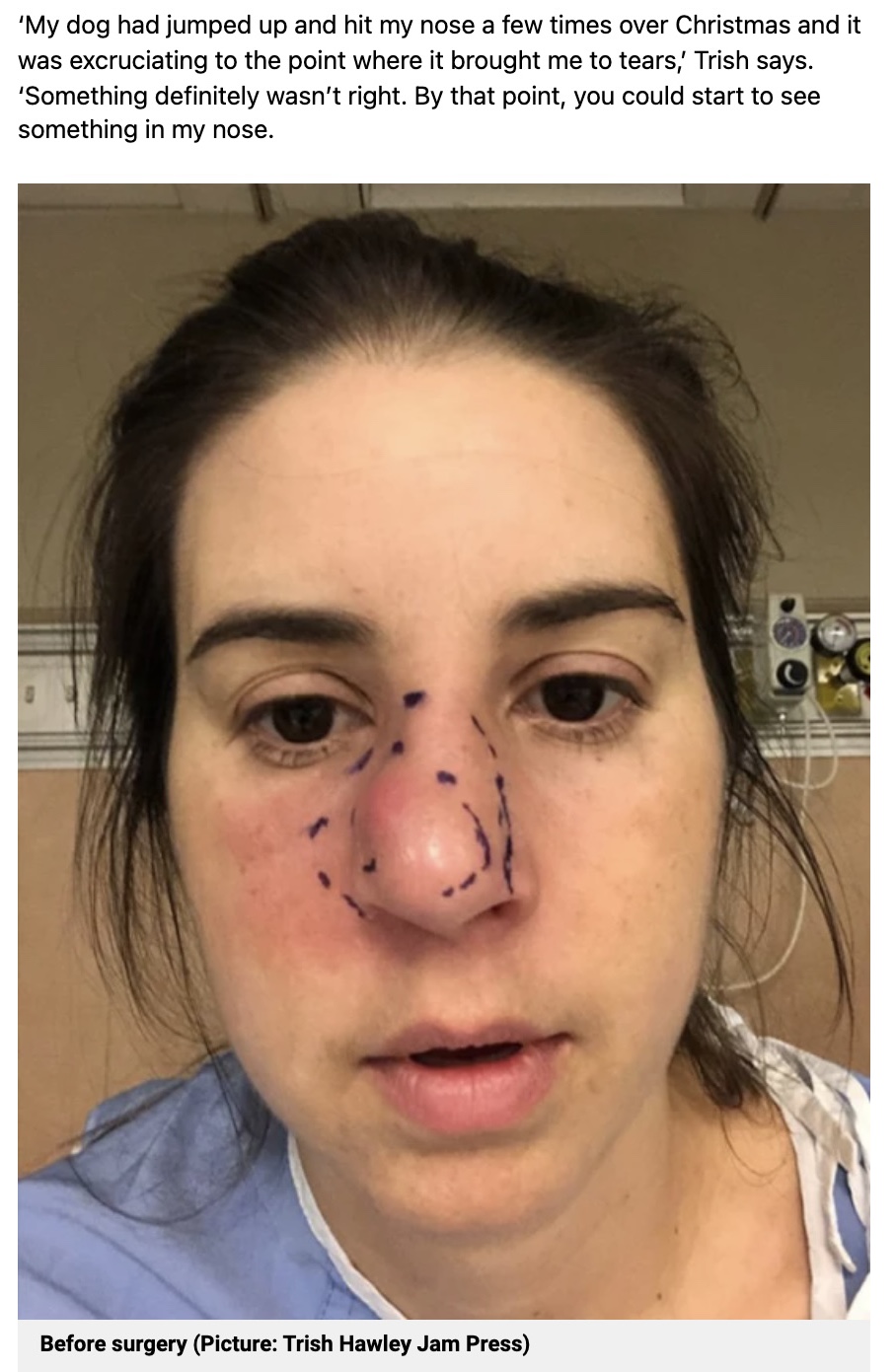 鼻の切除手術を受けたトリッシュさん（画像は『Metro　2022年2月17日付「Woman who felt pain while washing her face discovers tumour and has to have nose removed」（Picture: Trish/Jam Press）』のスクリーンショット）