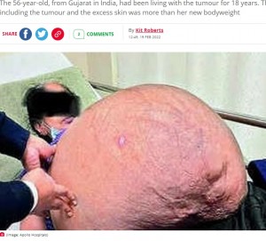 47キロもあった腫瘍（画像は『The Daily Star　2022年2月19日付「Woman confused by unexplained weight gain has gigantic 47kg tumour removed」（Image: Apollo Hospitals）』のスクリーンショット）