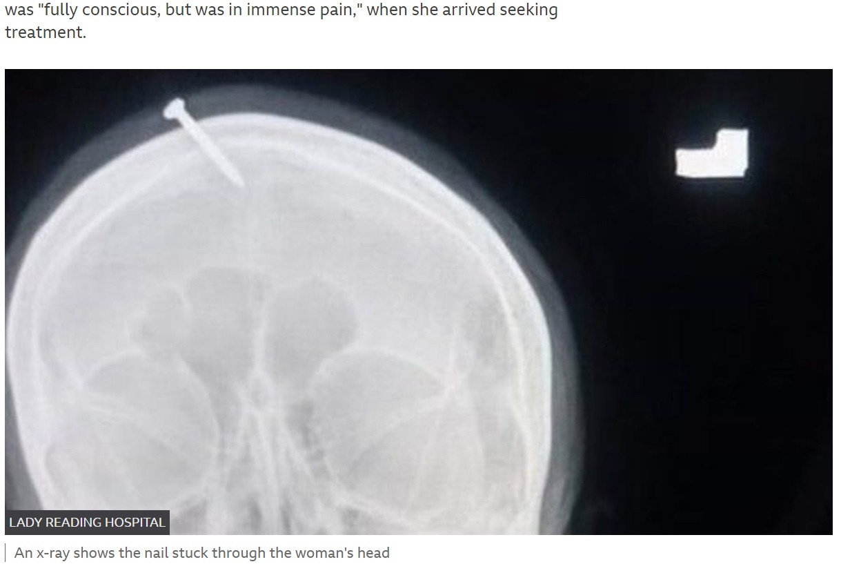 妊婦の頭部に刺さった釘（画像は『BBC　2022年2月9日付「Pakistan: Police hunt for ‘healer’ who hit nail into woman’s head」（LADY READING HOSPITAL）』のスクリーンショット）
