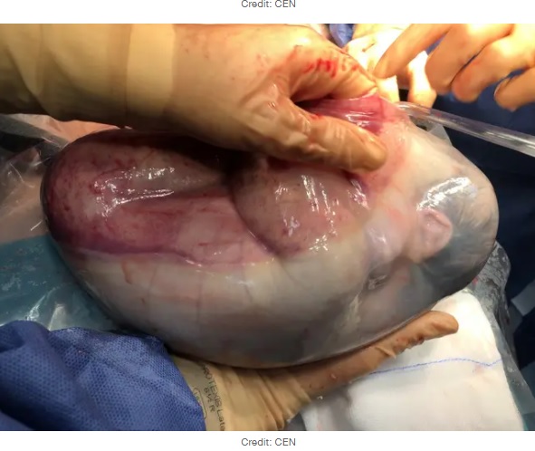 羊水の中で体を丸める胎児（画像は『LADbible　2022年3月26日付「​Twin Born Still Inside Amniotic Sac In Very Rare Event」（Credit: CEN）』のスクリーンショット）