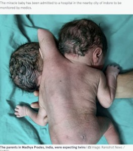 2つの頭の間から生える腕（画像は『The Mirror　2022年3月30日付「Baby born with two heads, three hands and two hearts after mum told to expect twins」（Image: Rareshot News / SWNS）』のスクリーンショット）