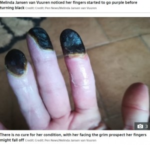 黒くなり壊死した指先（画像は『The Mirror　2022年3月17日付「Woman’s fingers turn black and are close to falling off after years of smoking」（Image: Credit: Pen News/Melinda Jansen van Vuuren）』のスクリーンショット）