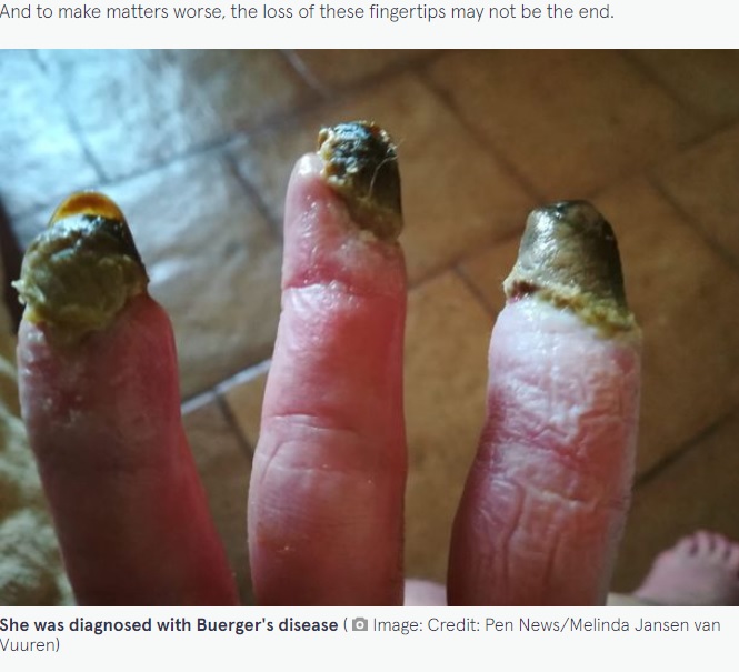 腐って落ちるのを待っている状態の指（画像は『The Sun　2022年3月16日付「MY HORROR My fingers have turned black and could FALL OFF after years of smoking」（Credit: Pen News/Melinda Jansen van Vuuren）』のスクリーンショット）